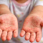 Campak di Kota Tasikmalaya Melonjak, Simak Imbauan Kemenkes RI