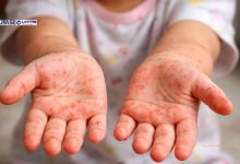 Campak di Kota Tasikmalaya Melonjak, Simak Imbauan Kemenkes RI