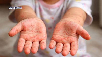 Campak di Kota Tasikmalaya Melonjak, Simak Imbauan Kemenkes RI