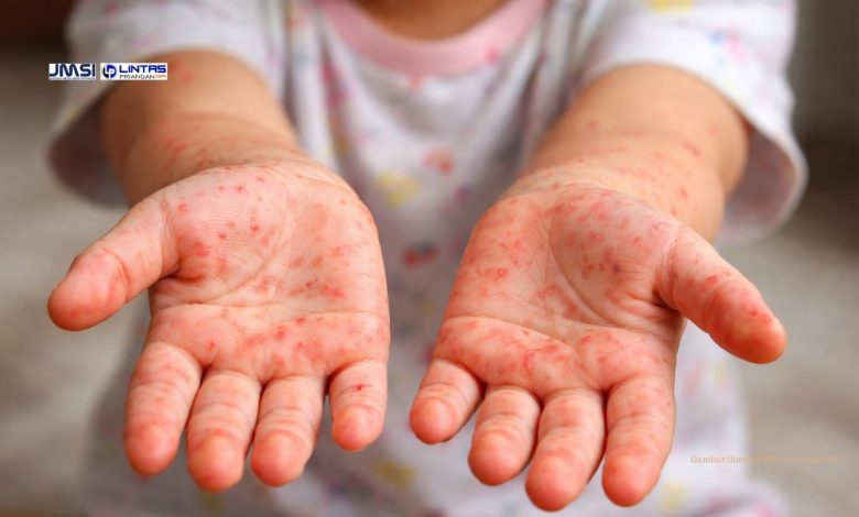 Campak di Kota Tasikmalaya Melonjak, Simak Imbauan Kemenkes RI
