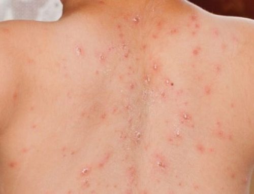 Campak di Kabupaten Tasikmalaya Masuk Status KLB, Waspada!