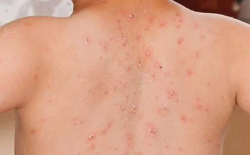 Campak di Kabupaten Tasikmalaya